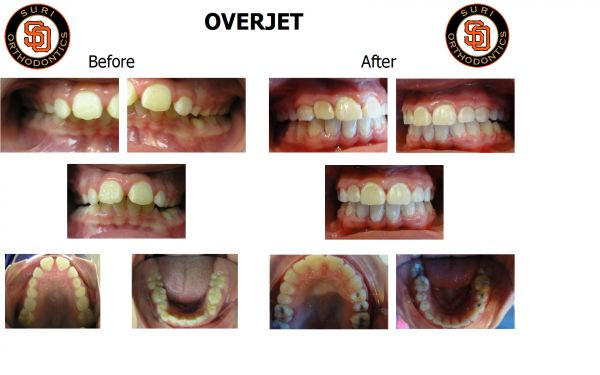 Overjet | Suri Orthodontics (501) 821-5859