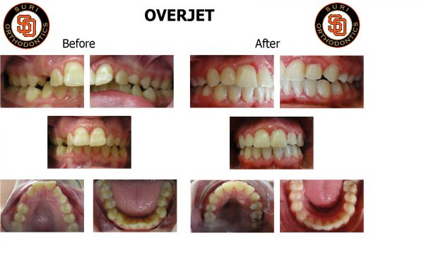 Overjet | Suri Orthodontics (501) 821-5859